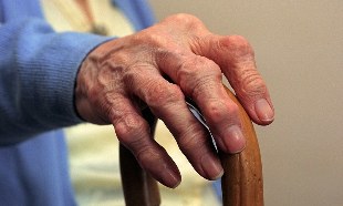Arthritis und Arthrose der Finger bei einer älteren Person. 
