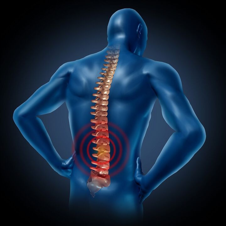 Rückenschmerzen im Lendenwirbelbereich. 