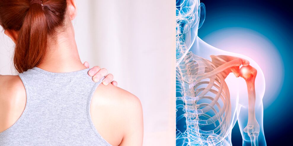 Die Entwicklung einer Arthrose der Schulter führt allmählich zu ständigen Schmerzen. 