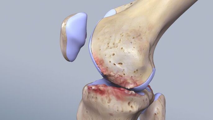 Die Struktur des Kniegelenks ist von der Pathologie betroffen. 