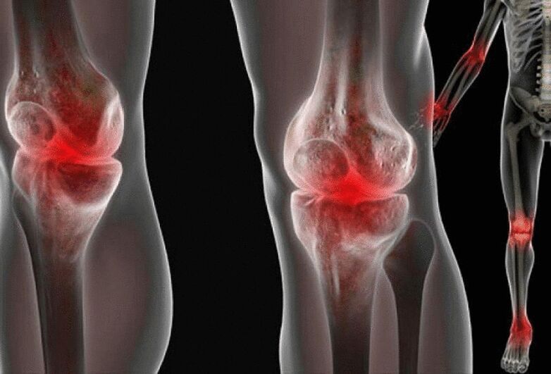Schmerzen in den Gelenken der Arme und Beine, die durch verschiedene Krankheiten verursacht werden. 