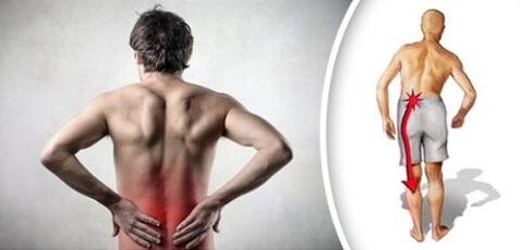 Schmerzsyndrom mit lumbaler Osteochondrose strahlt auf den Beinen aus