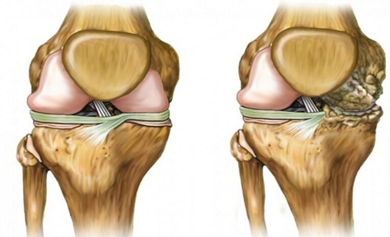 Gesund und durch gemeinsame Arthrose betroffen