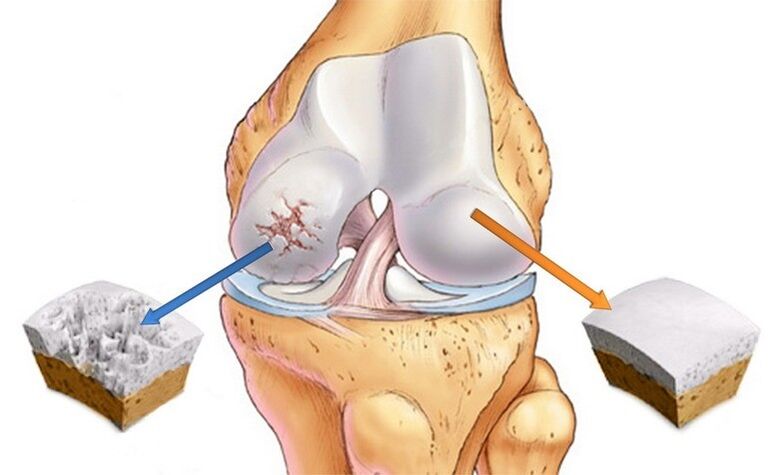 Normaler Knorpel und von Arthrinerie betroffen