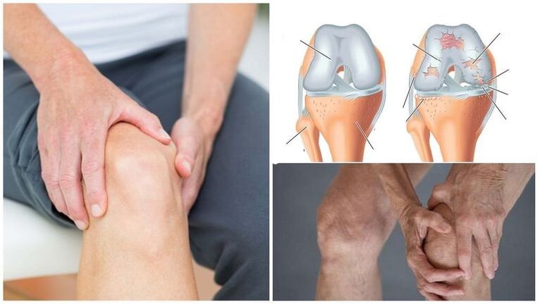 Symptom für Arthrose Kniefarbe des Kniegelenks