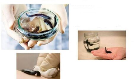 Hirudotherapie bei Arthrose